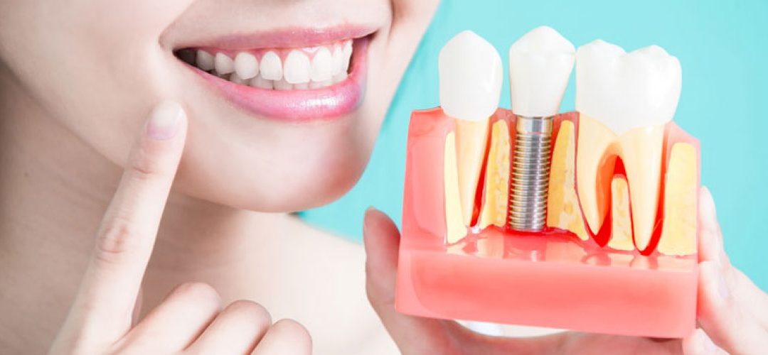 Dental Implant Aftercare Instructions