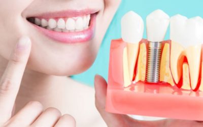 Replace Missing Teeth with Dental Implants by the Holidays