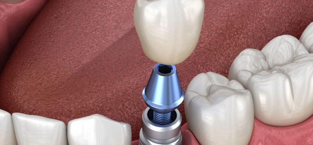 Dental Implants This Holiday Season