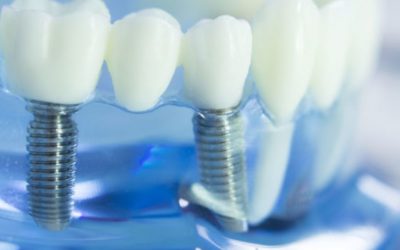 Are Your Dental Implants in Need of a Restoration?