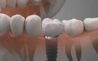 What Every Patient Should Know About Dental Implants