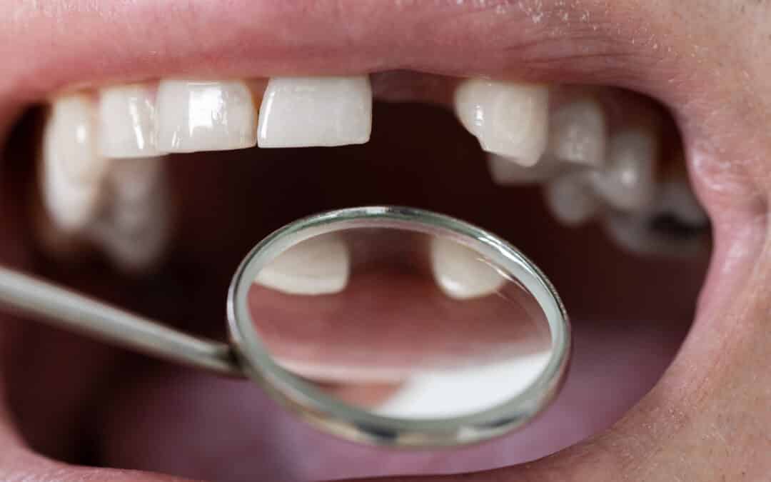 Will My Teeth Move While Waiting For An Implant?