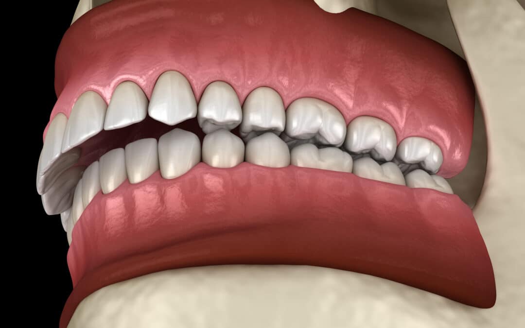 Correcting An Overbite Or Underbite With Dental Implants