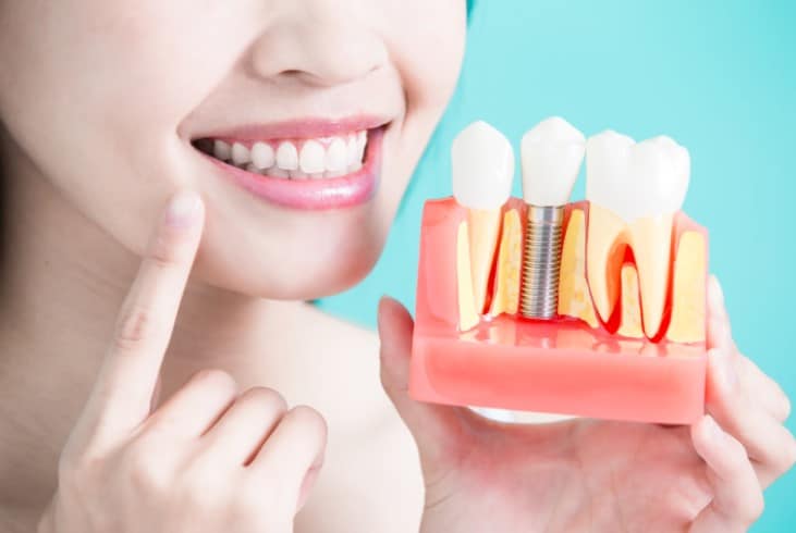 Tips For Prolonging The Life Of Your Dental Implants