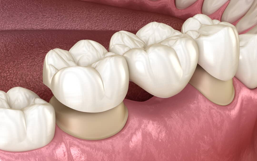 The Downsides Of Dental Bridges: What You Need To Know