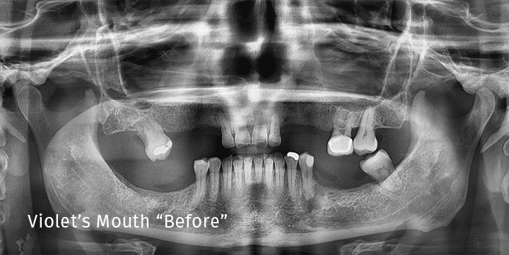 Patient teeth before full-mouth dental implant procedure