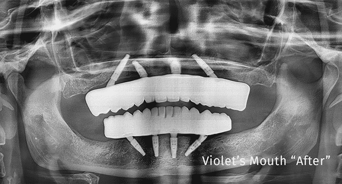 Patient smile after full-mouth dental implant transformation