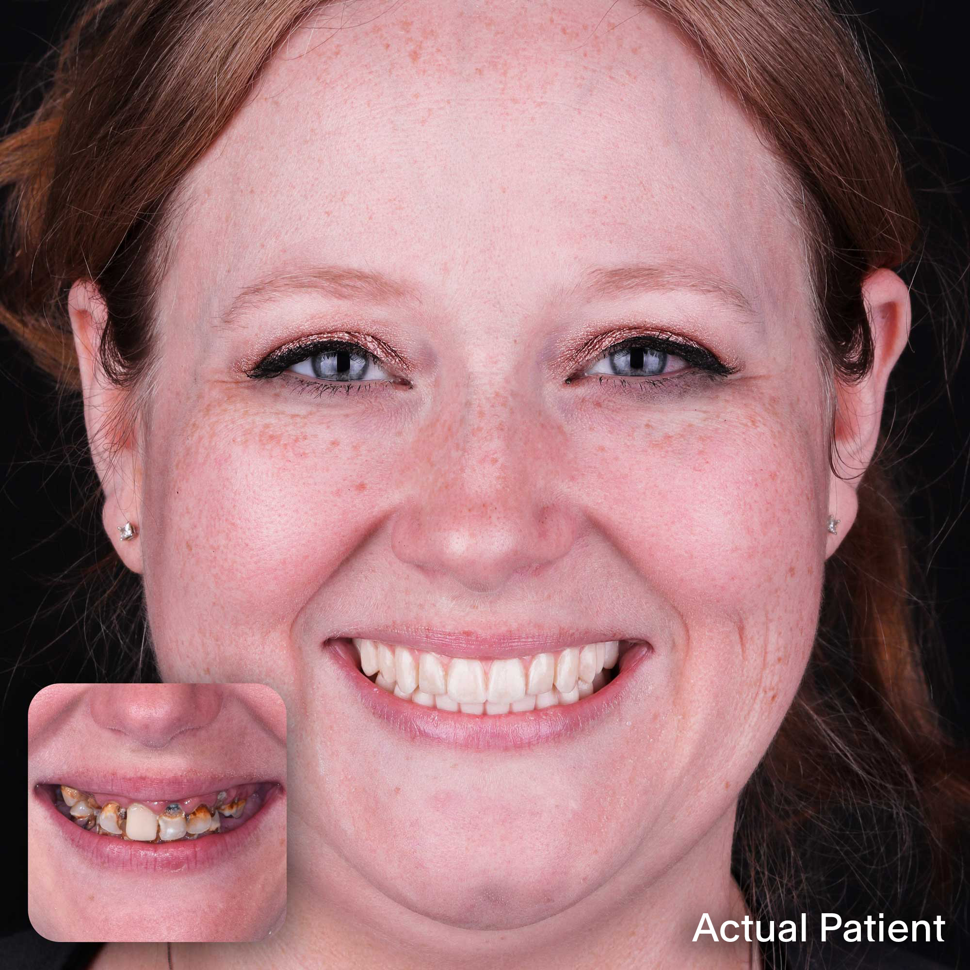 Kayla, Doctors Implants Patient