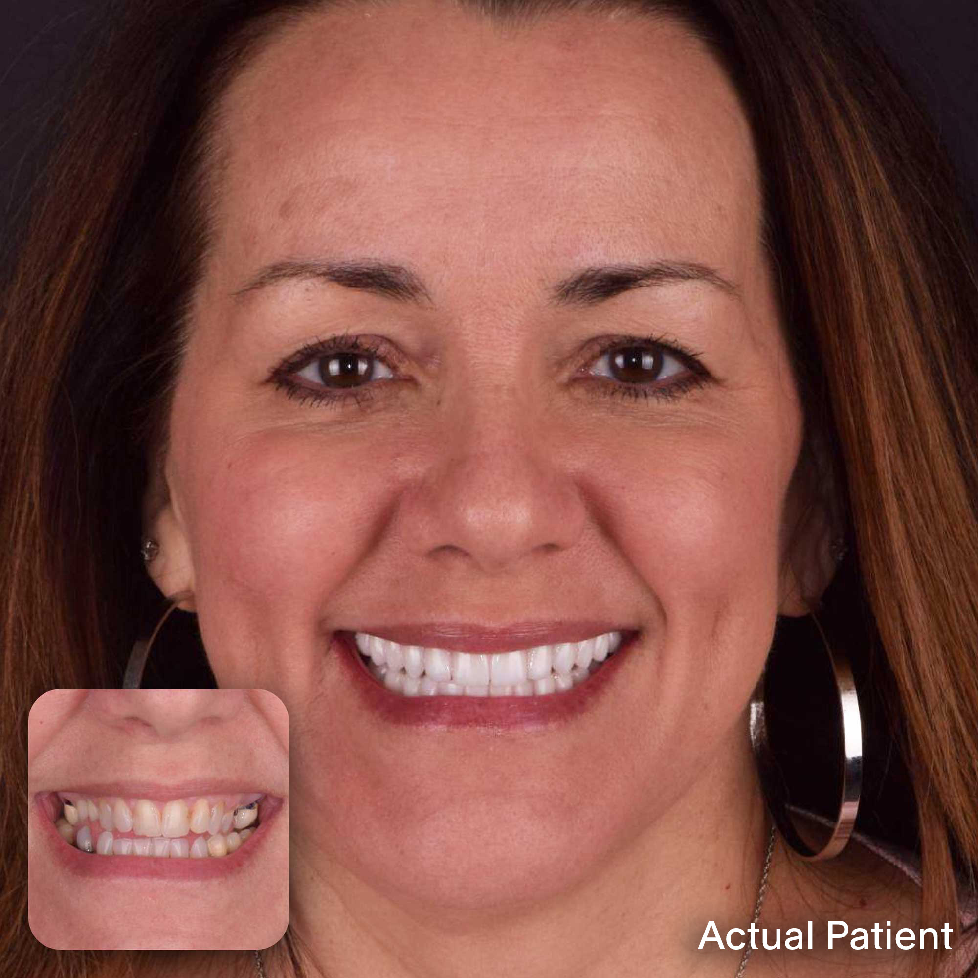 Amy, Doctors Implants Patient