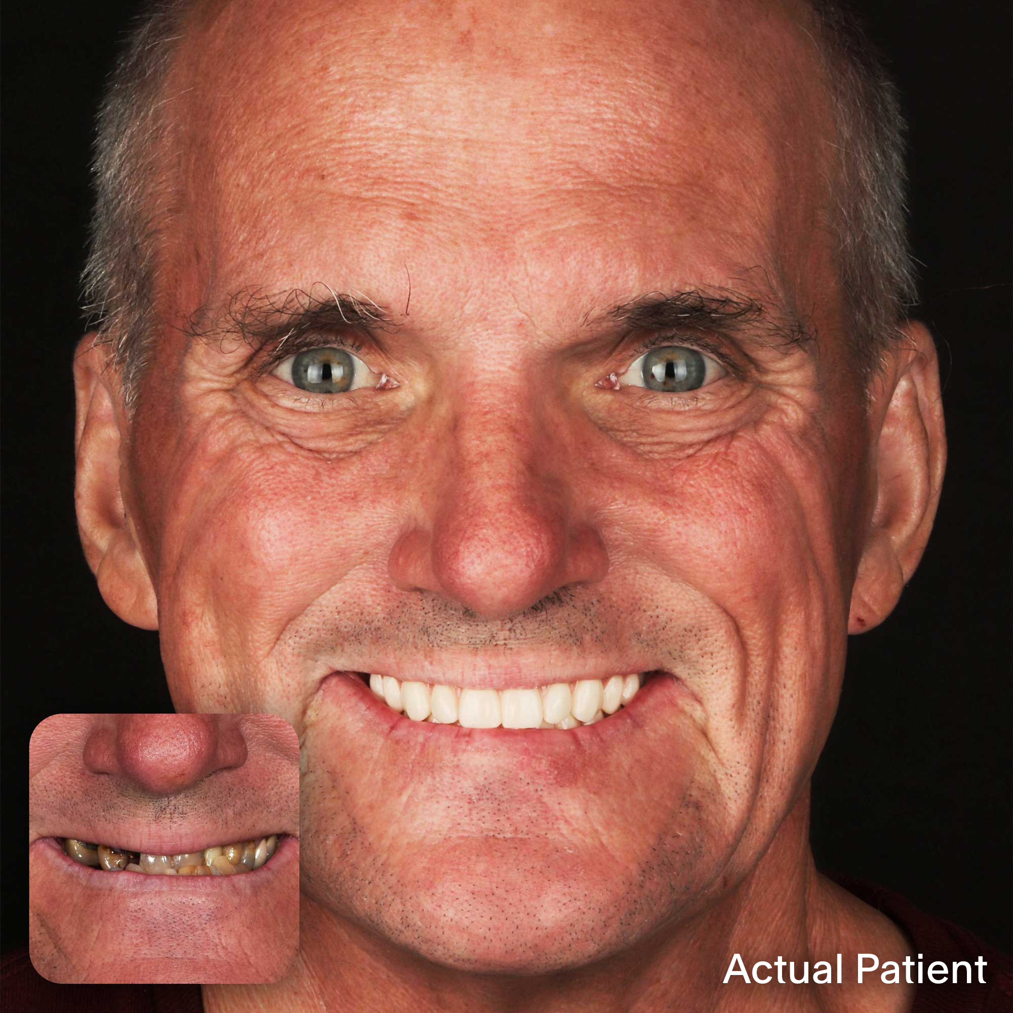 Baker, Doctors Implants Patient