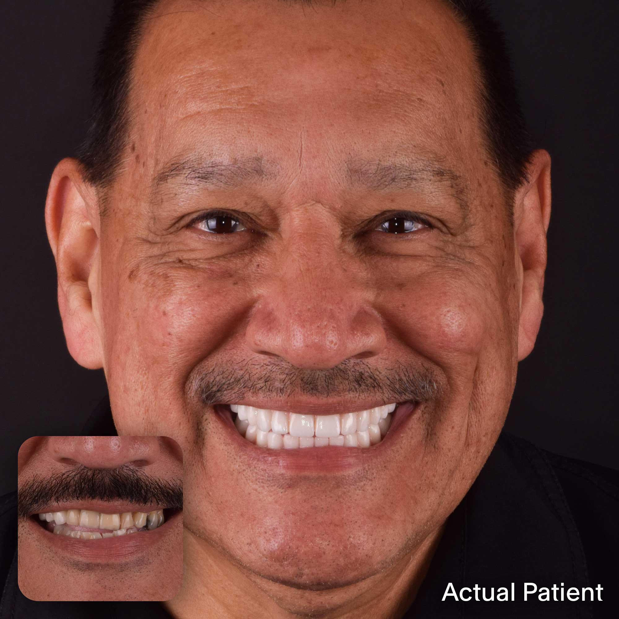 Doctors-Implants-Before-And-Afters-Johnny