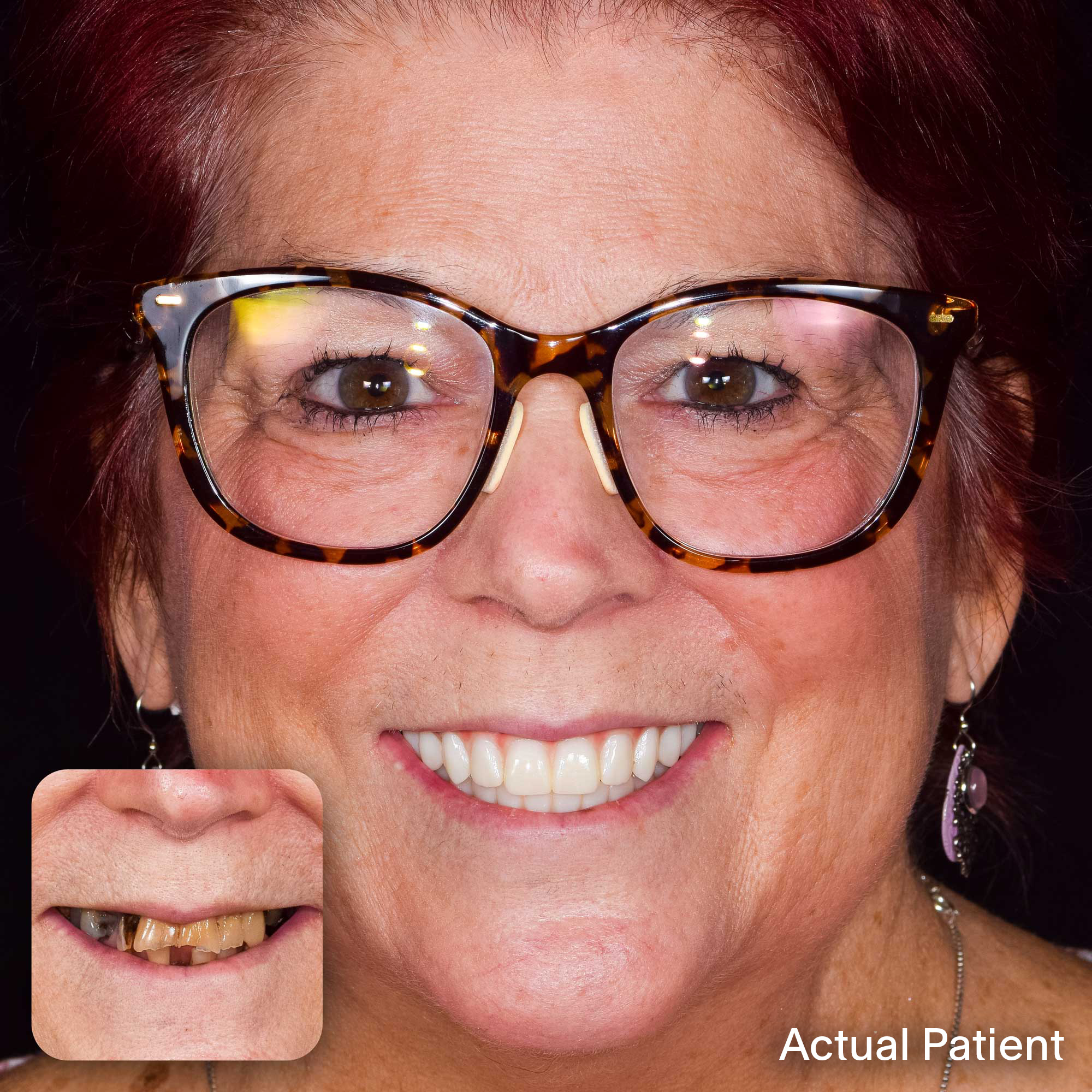 Kathy, Doctors Implants Patient