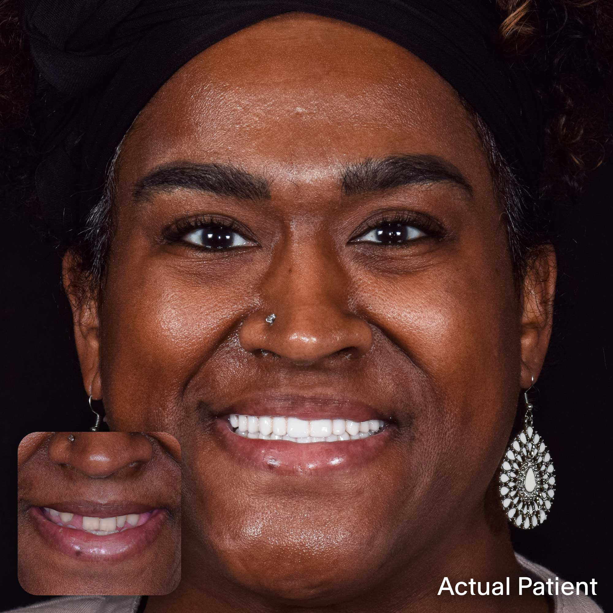 Kiona, Doctors Implants Patient