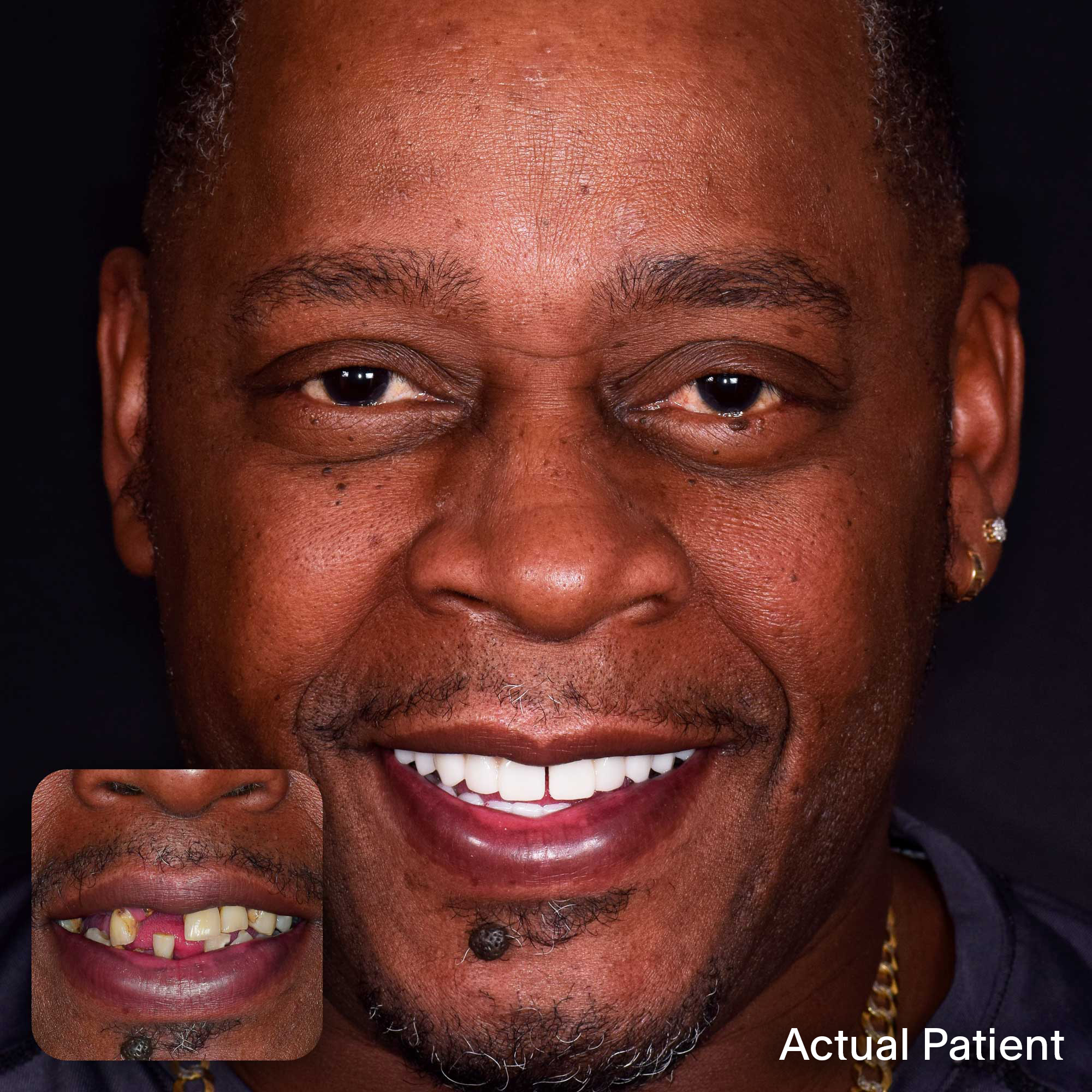 Tyrone, Doctors Implants Patient