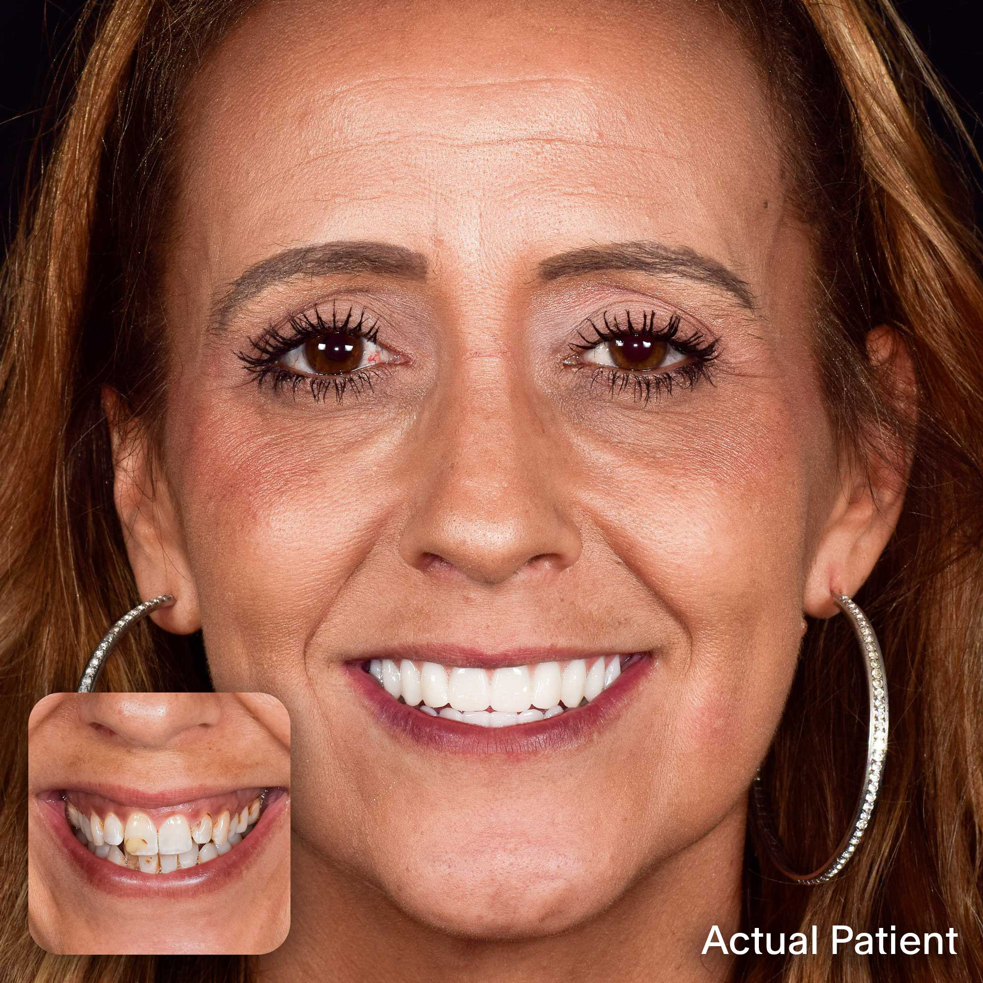 Stephany, Doctors Implants Patient