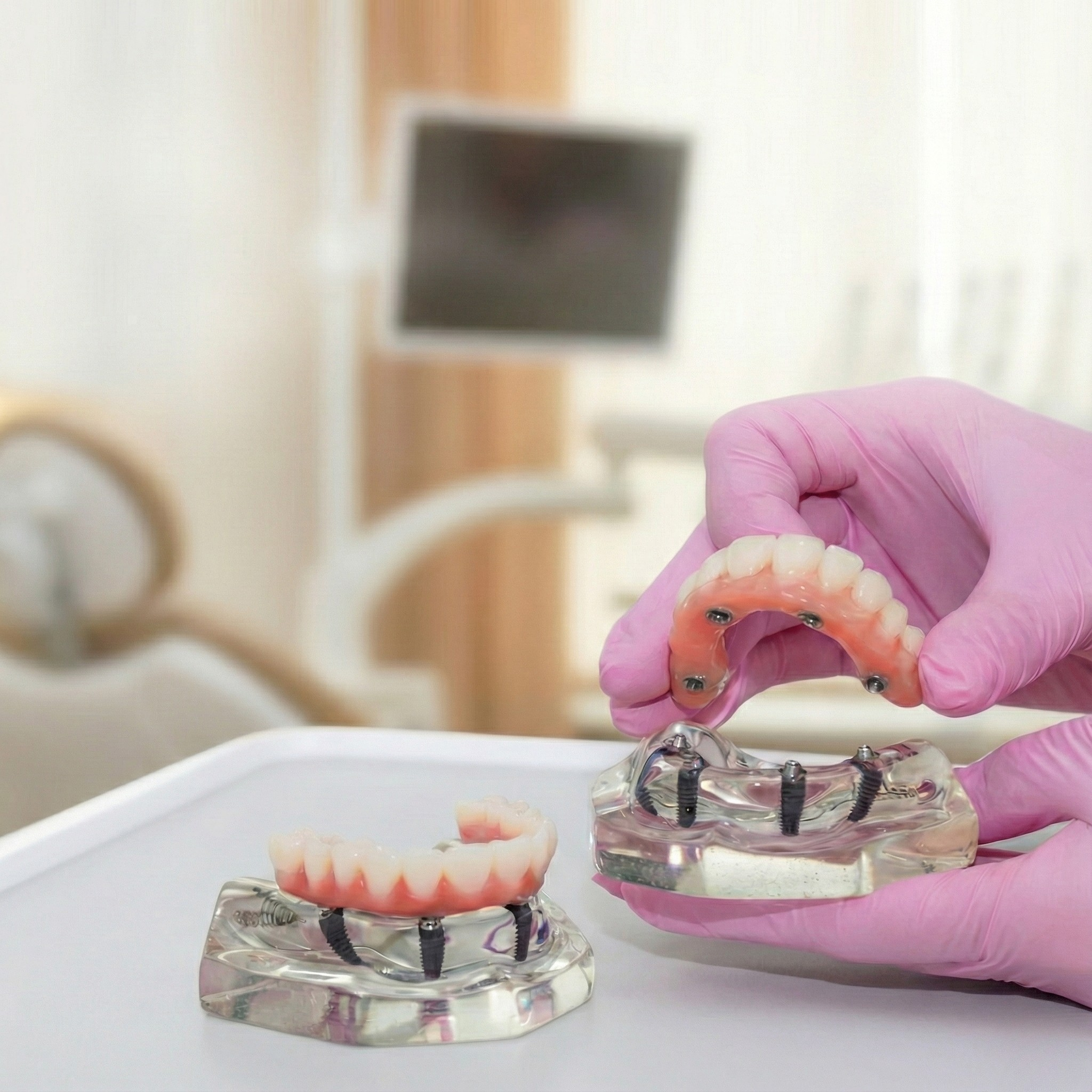 What is an Arch in Dentures and Dental Implants
