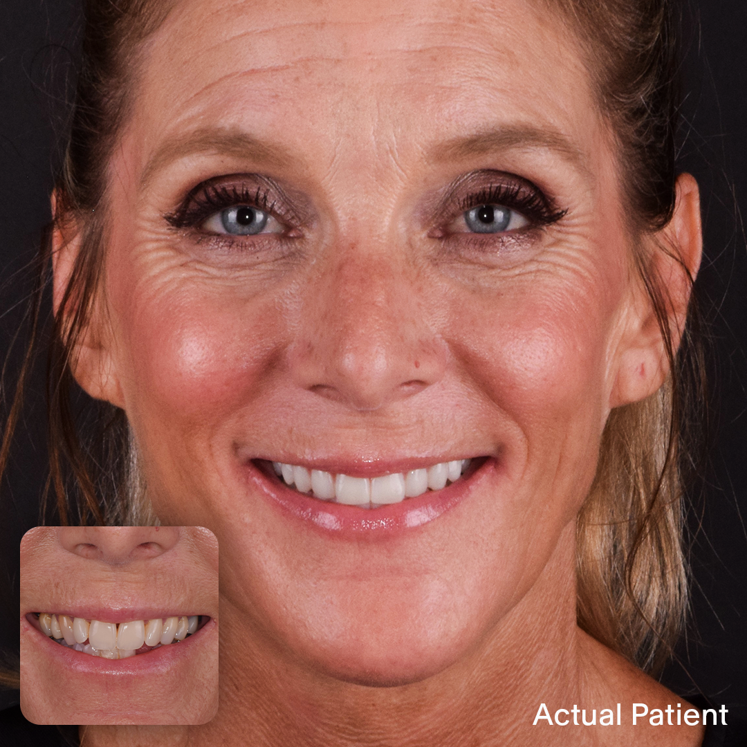 Amy, Doctors Implants Patient