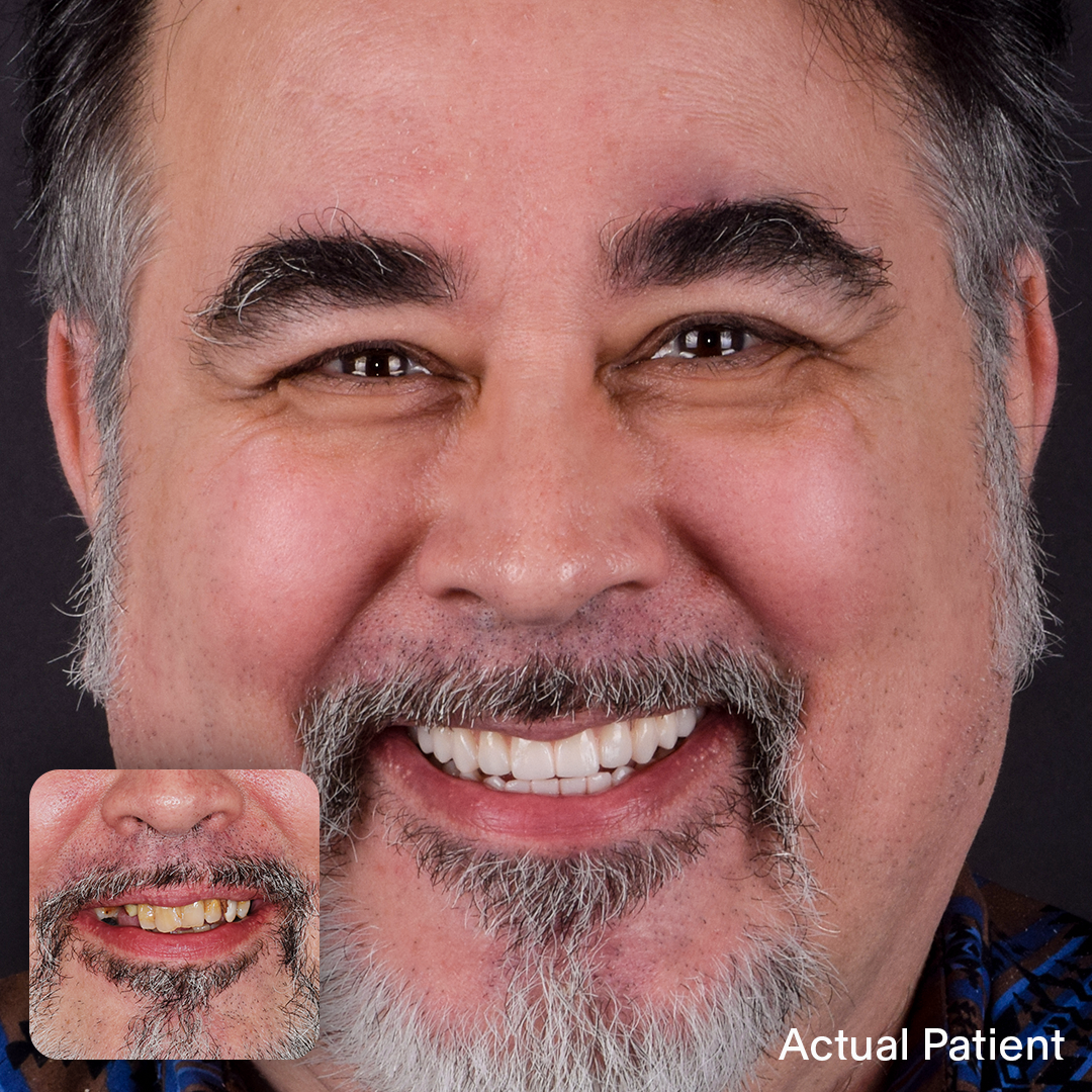 Burt, Doctors Implants Patient