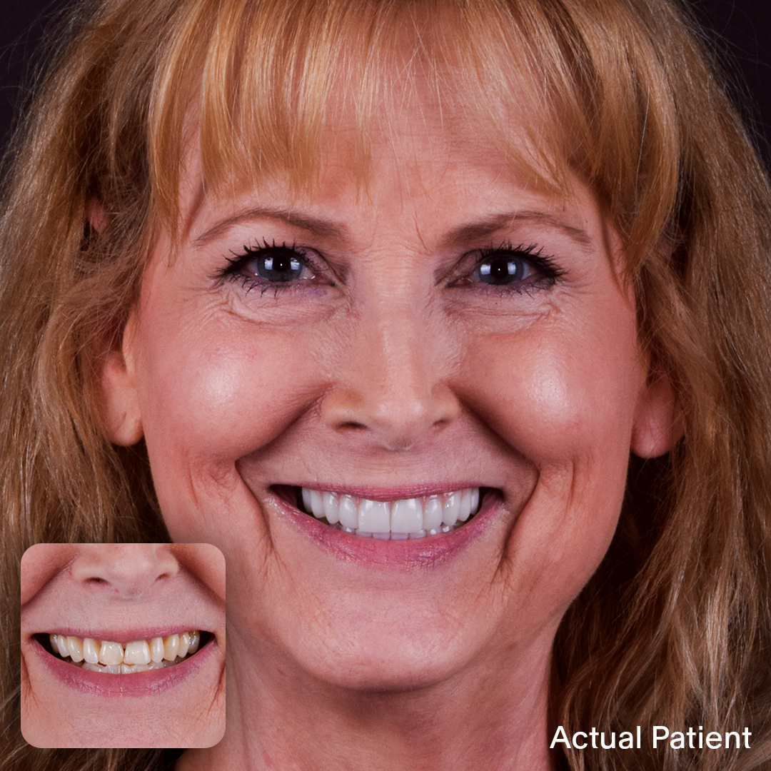 Diane, Doctors Implants Patient